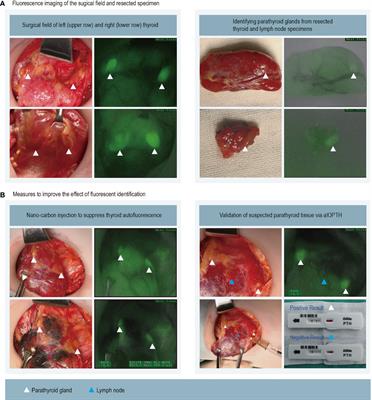 Evaluation of Autofluorescence in Identifying Parathyroid Glands by Measuring Parathyroid Hormone in Fine-Needle Biopsy Washings